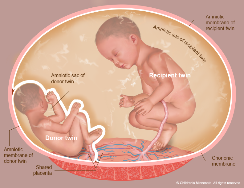 Twin to twin transfusion diagram -- diamniotic twins connecting vessels