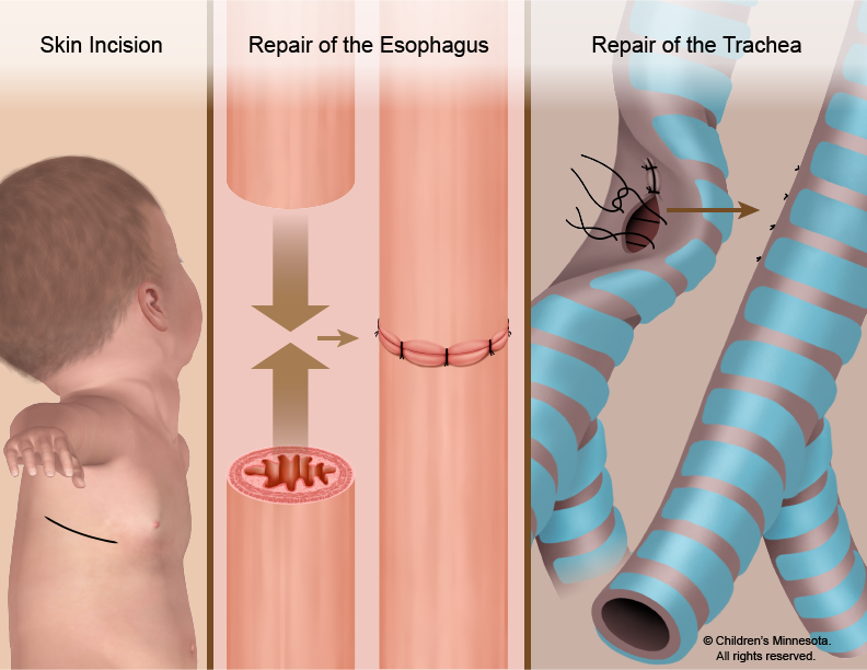 Esophageal artesia repair illustration