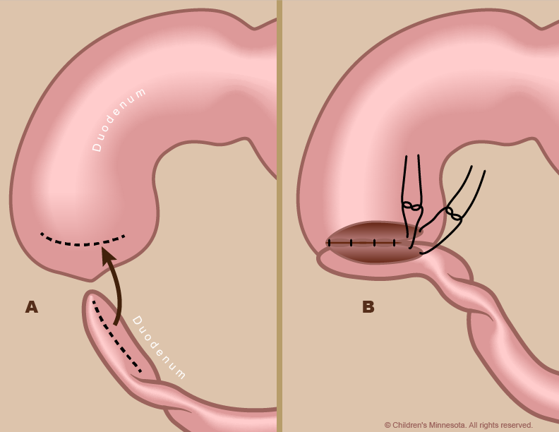Figure 5 - During surgery to repair duodenum atresia, the surgeon opens up the blocked ends of the duodenum (A) and then sutures them together (B).