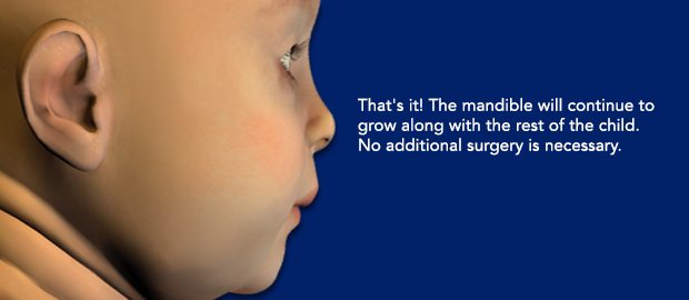That's it! The mandible will continue to grow along with the rest of the child. No additional surgery is necessary.