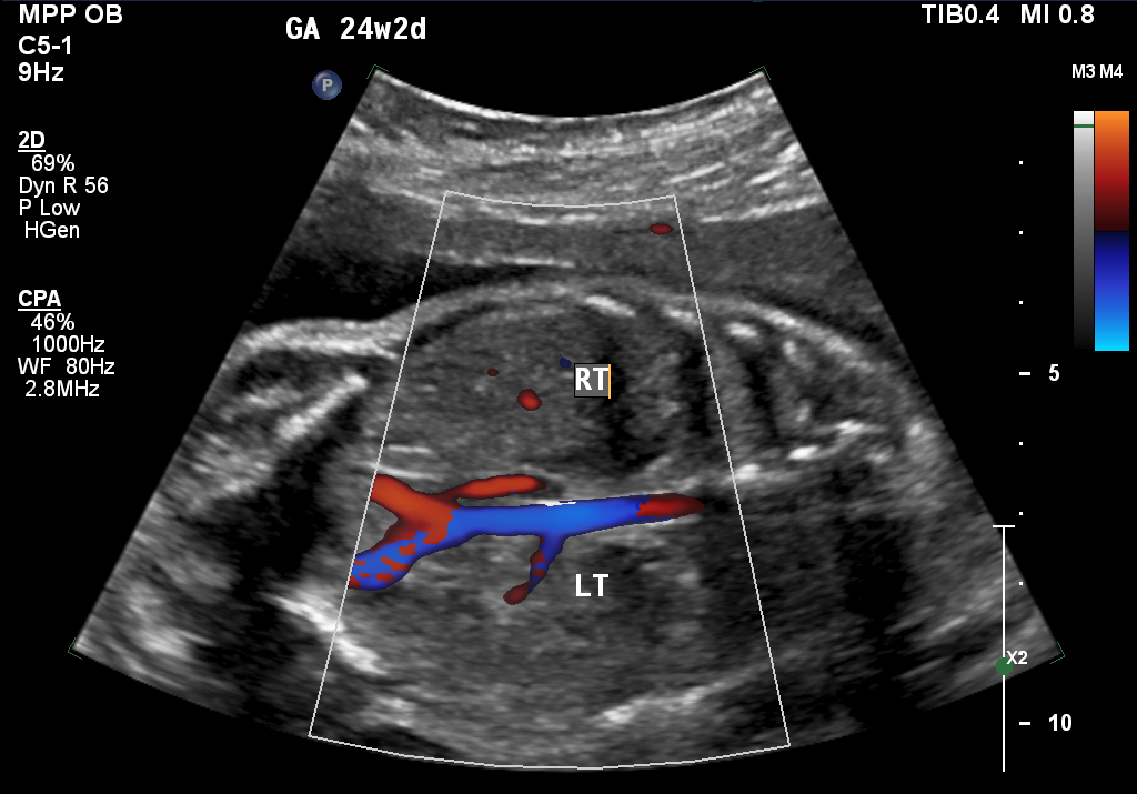MWFCC Conditions Renal Agenesis Children s Minnesota