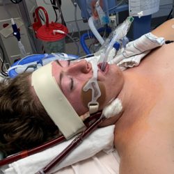 Teen boy in hospital bed with breathing support due to vaping.