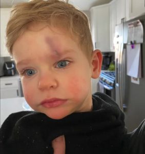 Hudson after his fall