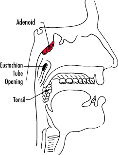 Adenoidectomy | Adenoid Removal | Childrens Minnesota