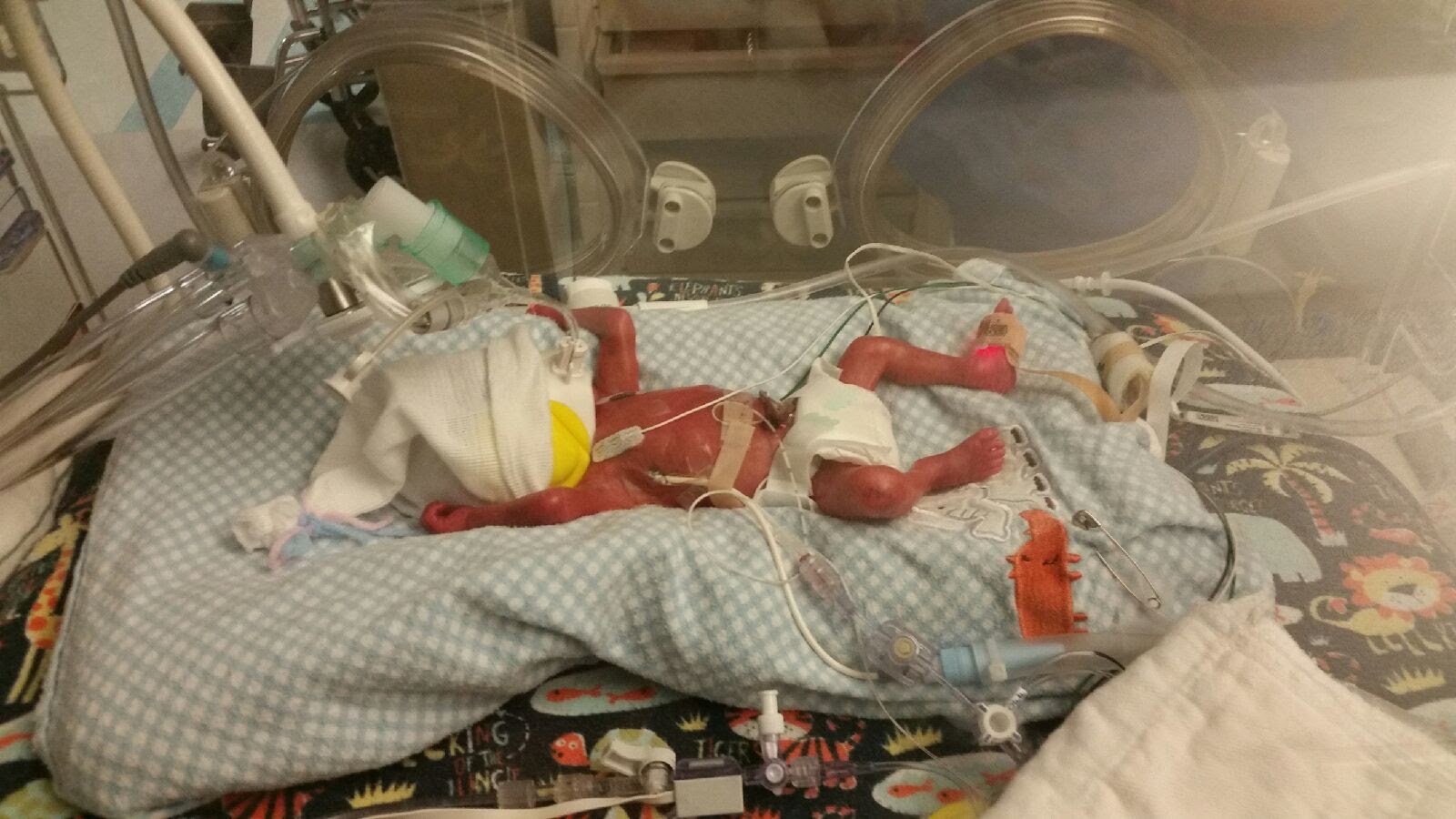 Marshall Keller in the NICU during the first days of his life.