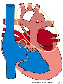 Heart with hypoplastic left heart syndrome