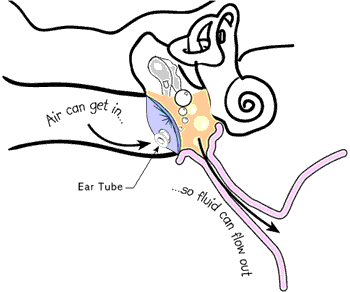 an illustration shows an ear tube in place in the ear drum, allowing air to enter into the middle ear space so fluid can flow out.