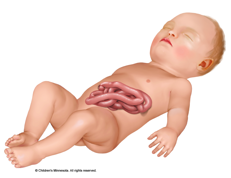 illustration of a newborn with intestines outside of the stomach