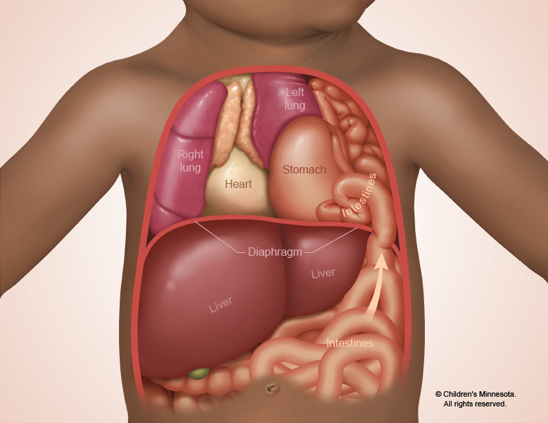 A hole in the diaphragm causes the intestines, stomach and other abdominal organs to move up into the thoracic cavity, shifting the heart and lungs from left to right.