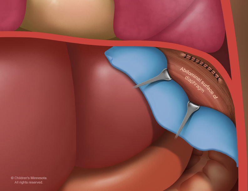 A small hole can sometimes be repaired by surgically sewing it closed. This is known as a “primary” repair.