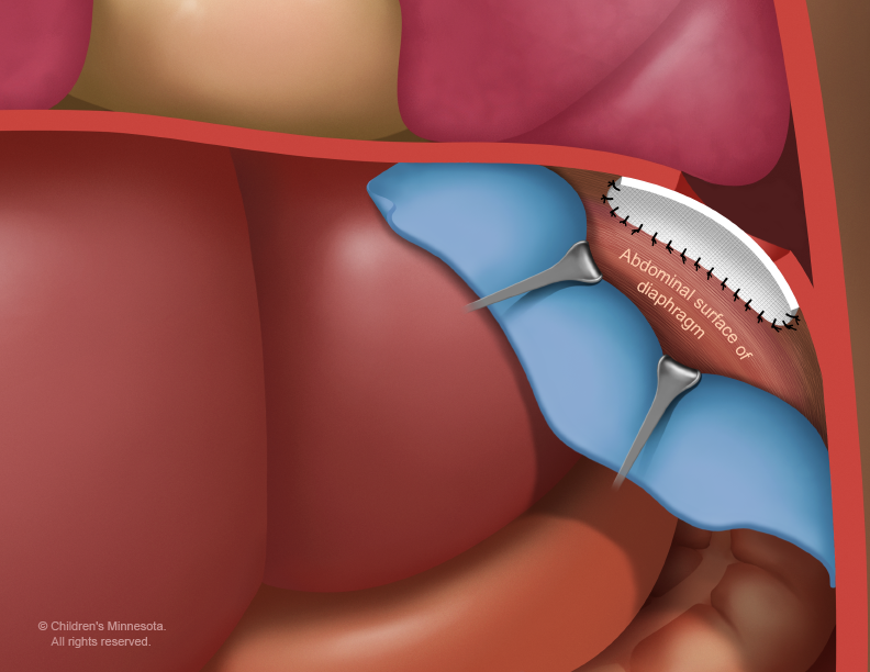 During “patch” surgery, the surgeon repairs the hole in the baby’s diaphragm with a synthetic, biocompatible material (white). A surgical towel (blue) and two retractors (gray) are used to expose the area while the patch is sewn.