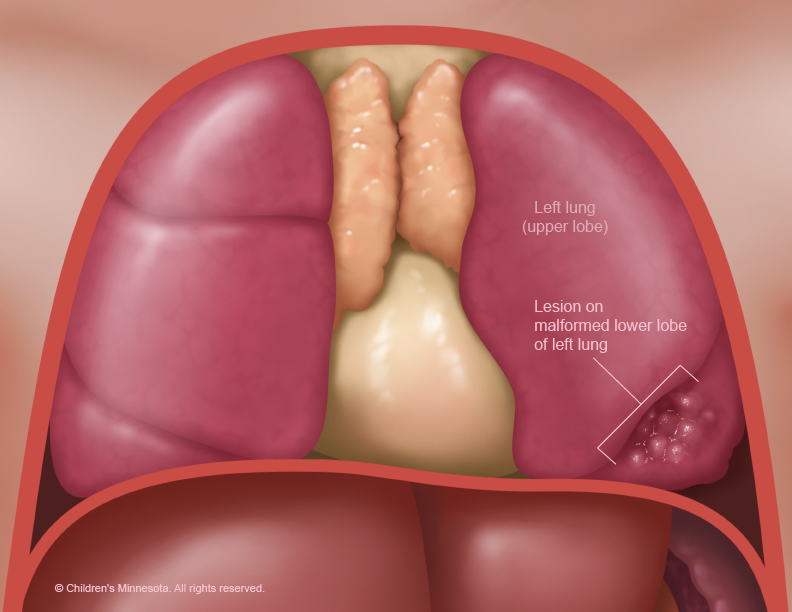 A cystic lesion in the malformed lower lobe of the left lung