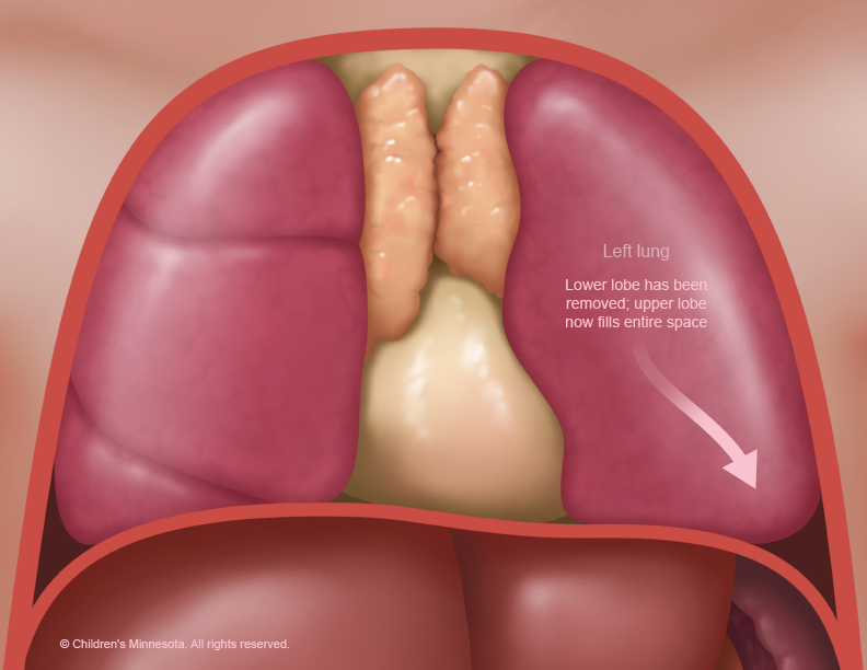 After removal of the malformed lobe, the remaining lobe expands to occupy the entire left chest cavity