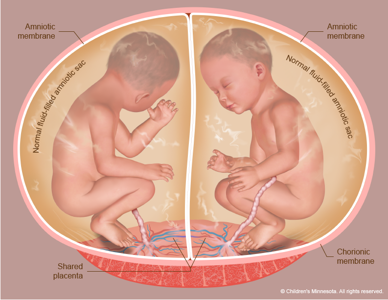 Twin to Twin transfusion diagram - Normal diamniotic twins