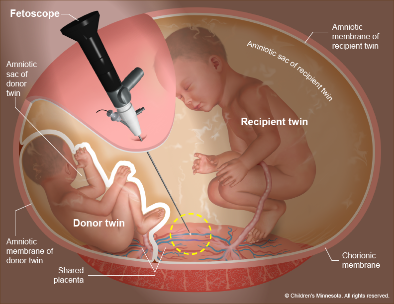 Twin to twin transfusion illustration -- Operative fetoscopy diamniotic twins