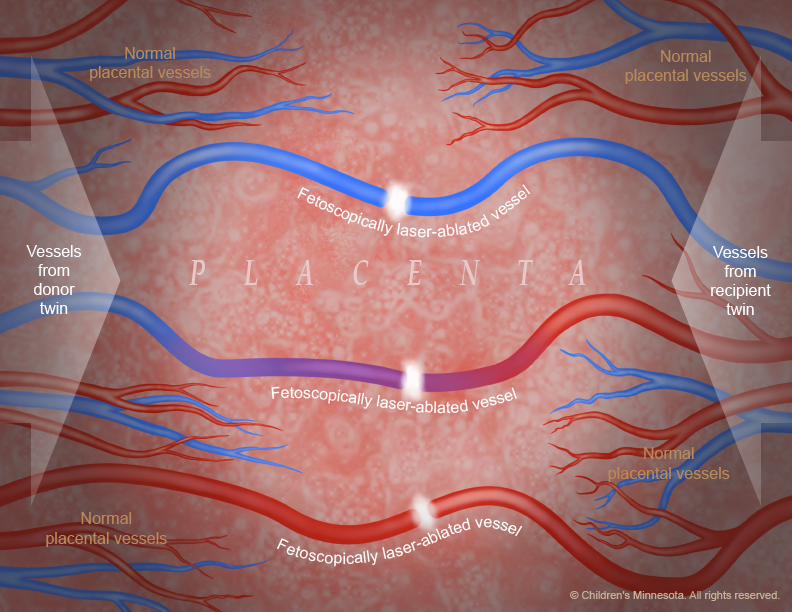 Twin to twin transfusion illustration -- Laser ablated vessels close up