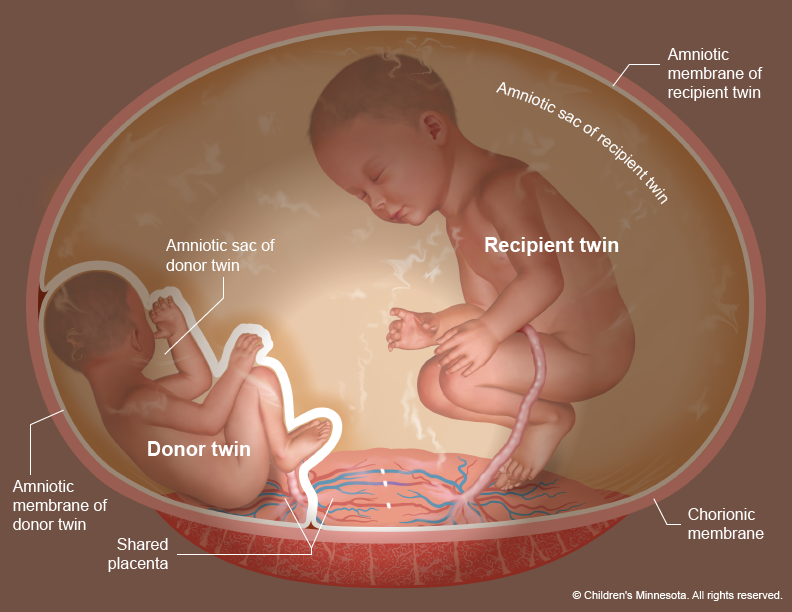 Twin to Twin transfusion illustration -- post-ablation broad view