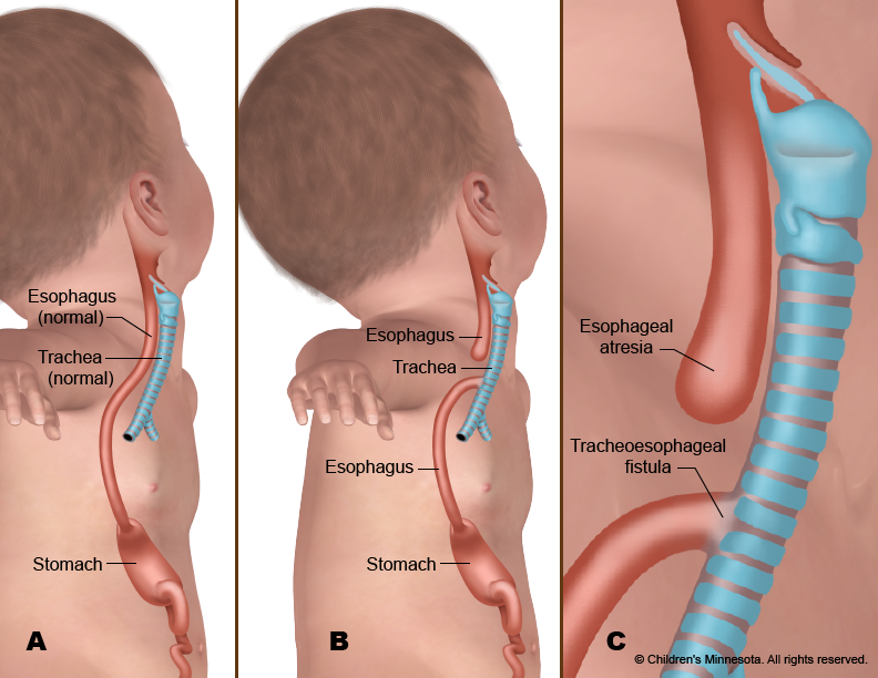 Diagram of the anatomy of an esophageal atresia
