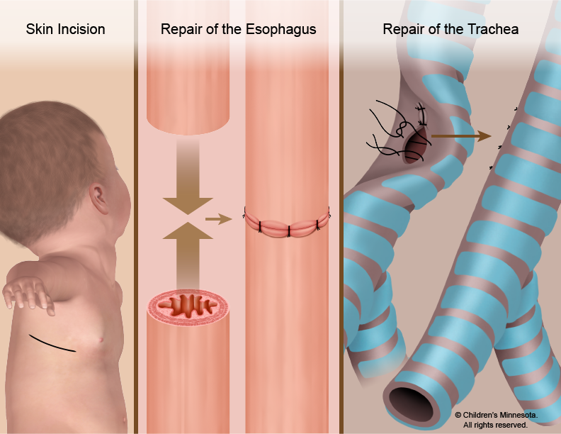 Esophageal atresia