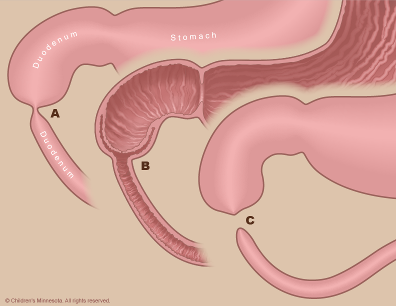 Figure 4 - Incomplete obstructions (A) are known as duodenal “webs” because of the web-like membrane that forms inside the duodenum at the point of the obstruction (B). Complete duodenal atresia occurs when a segment of the duodenum is absent (C).