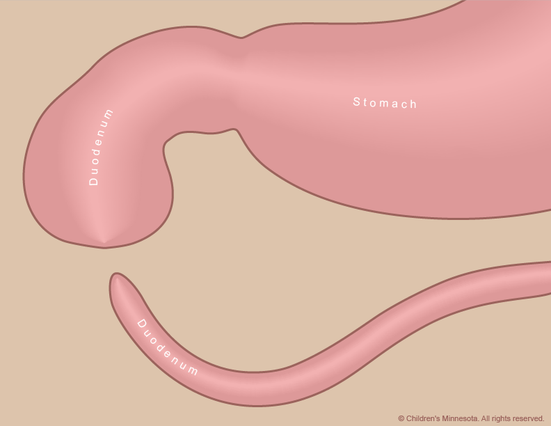 Figure 2 - A duodenal atresia