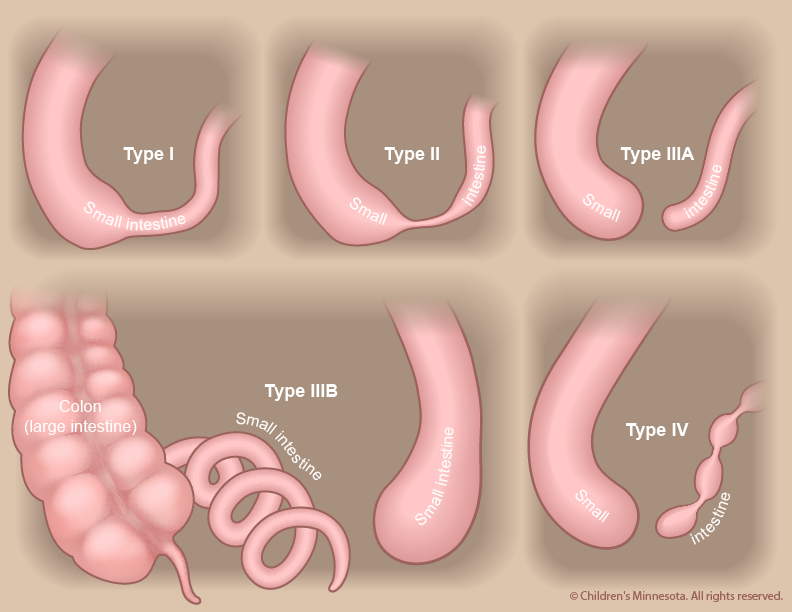 Figure 2 - The type of blockage determines how intestinal atresia is classified.