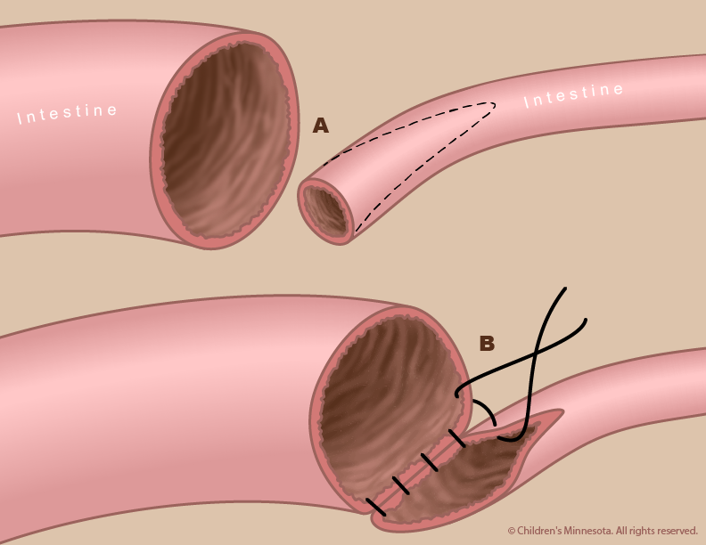 Figure 3 - After removing the atresia, the surgeon repairs the intestine by sewing the two separated ends together.