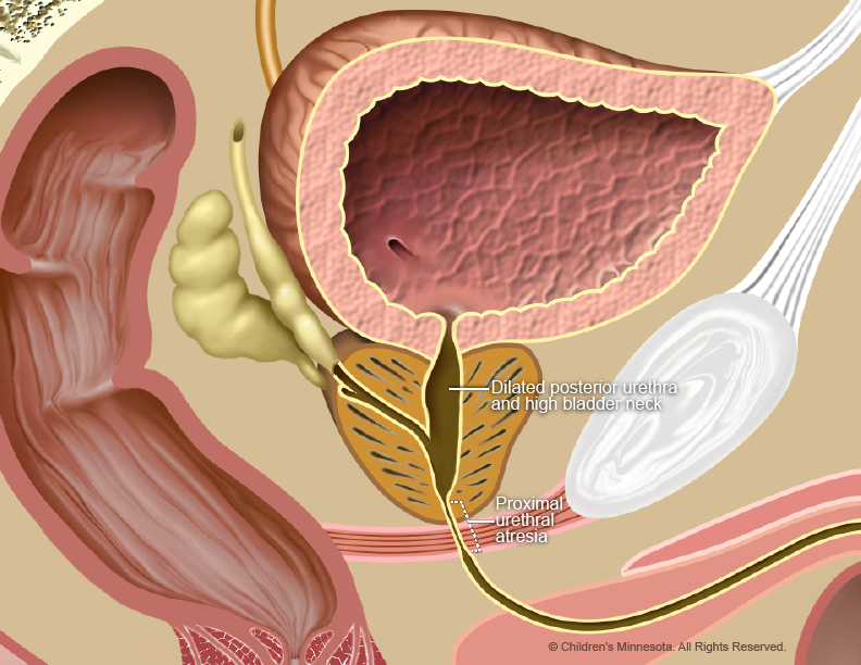 Urethral Atresia; Children's MN Midwest Fetal