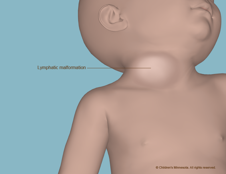 Image of a lymphatic malformation in the baby's neck