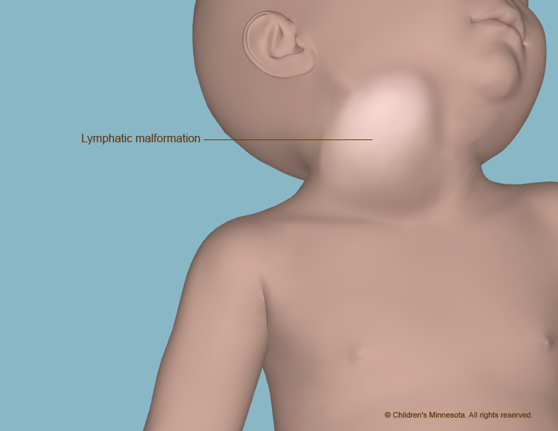 Image of a lymphatic malformation in the neck and cheek in baby