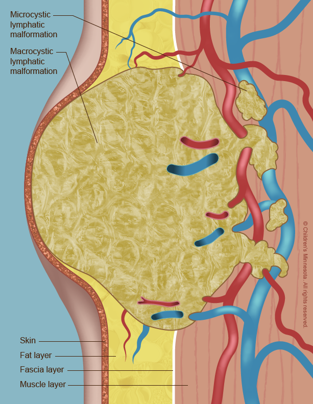 A lymphatic malformation (show here in the neck) can expand from the skin into nearby muscles, blood vessels, and, in some cases, nerves on a baby