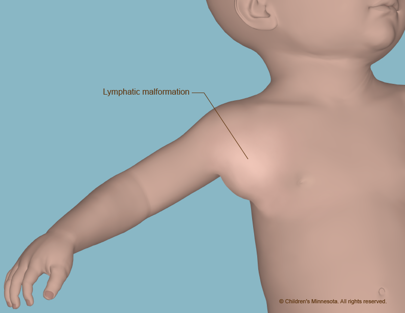 Image of a lymphatic malformation in the armpit (axilla) in baby