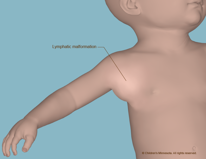 a large bump under the skin of the armpit area of an infant.