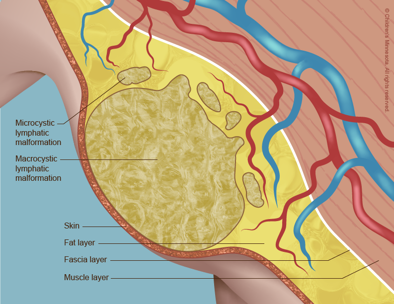 Some lymphatic malformations (shown here in the armpit) remain within the layers of the skin on a baby