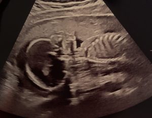 Ultrasound of Stella