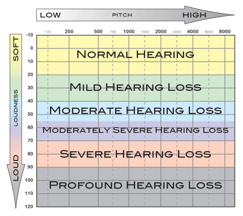 a chart showing loudness from soft at the top, to loud at the bottom. Along the x axis, is pitch, with low to the left and high to the right. Normal hearing is in the -10 to 20 loudness range; mild hearing loss is 20-40 loudness; 40-55 is moderate hearing loss; 55-70 is moderately severe hearing loss; 70-90 is severe hearing loss; and anything beyond that is profound hearing loss. All of these hearing levels are across all pitch ranges