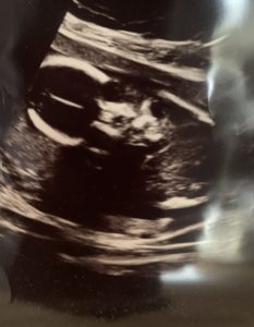 Baby Jagger ultrasound
