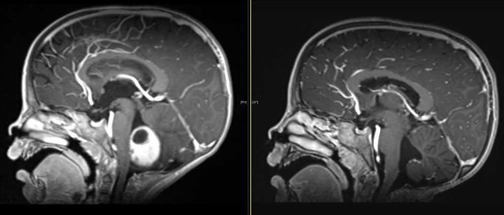 An MRI of Camille's head