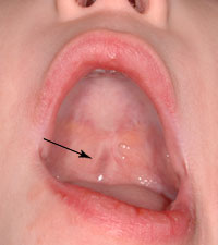 cleftpalate1