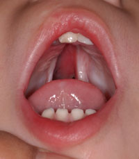 a larger cleft palate that covers the full roof of the mouth