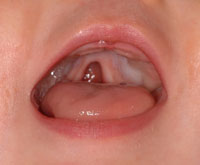 cleftpalate3