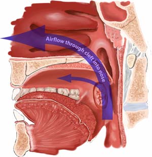 cleftpalate4