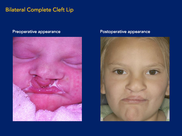 Bilateral Complete cleft lip