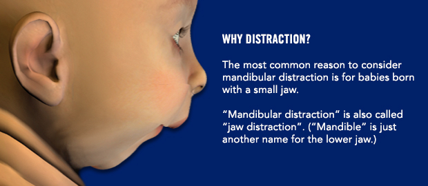 Why distraction? The most common reason to consider mandibular distraction is for babies born with a small jaw. "Mandibular distraction" is also called "jaw distraction". ("mandible" is just another name for lower jaw.)