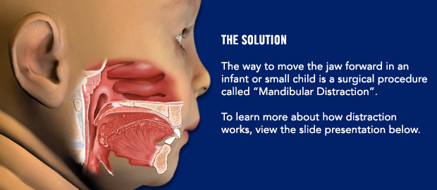 The solution. The way to move the jaw forward in an infant or small child is a surgical procedure called "Mandibular Distraction." To learn about how distraction works, view the slide presentation below.