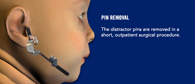 Pin Removal