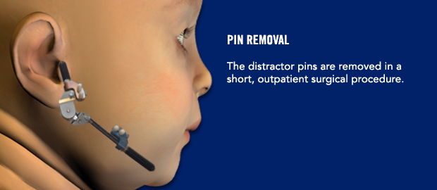 Pin removal The distractor pins are removed in a short, outpatient surgical procedure.
