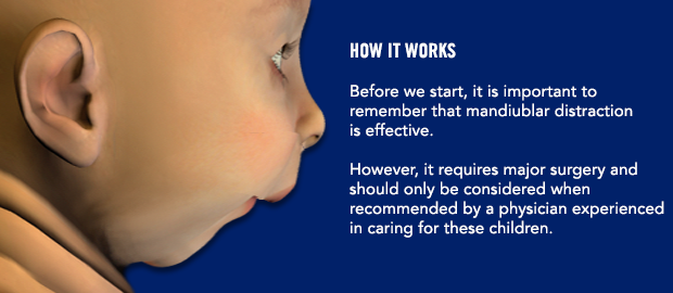 How it works. Before we start, it is important to remember that mandibular distraction is effective.