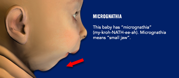 Micrognathia