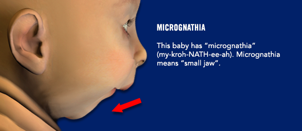 Micrognathia. This baby has "micrognathia" (my-kroh-NATH-ee-ah). Micrognathia means "small jaw". Image shows a baby with a smaller than average lower jaw.